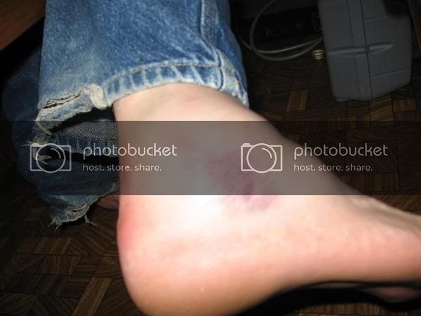 ankle1.jpg